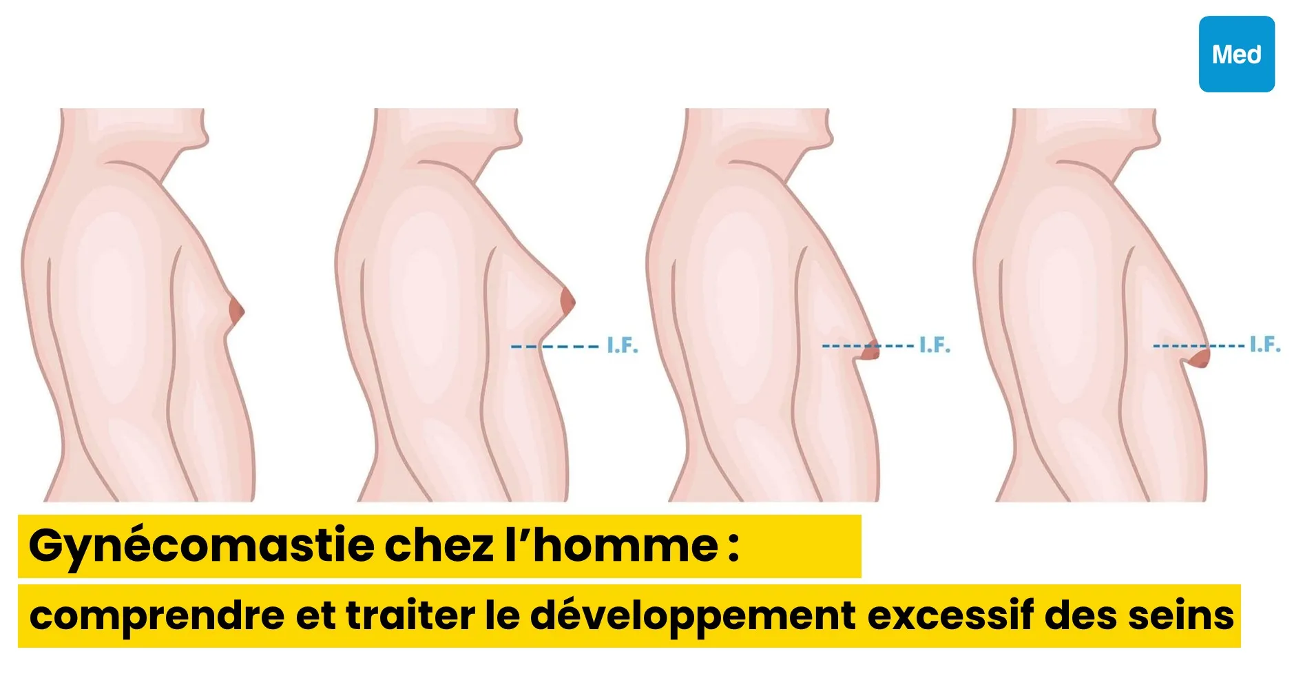 Gynécomastie chez l’homme : comprendre et traiter le développement excessif des seins